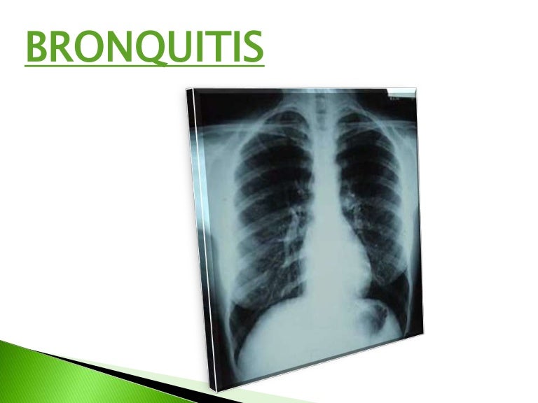 Bronquitis Asmatiforme Pdf